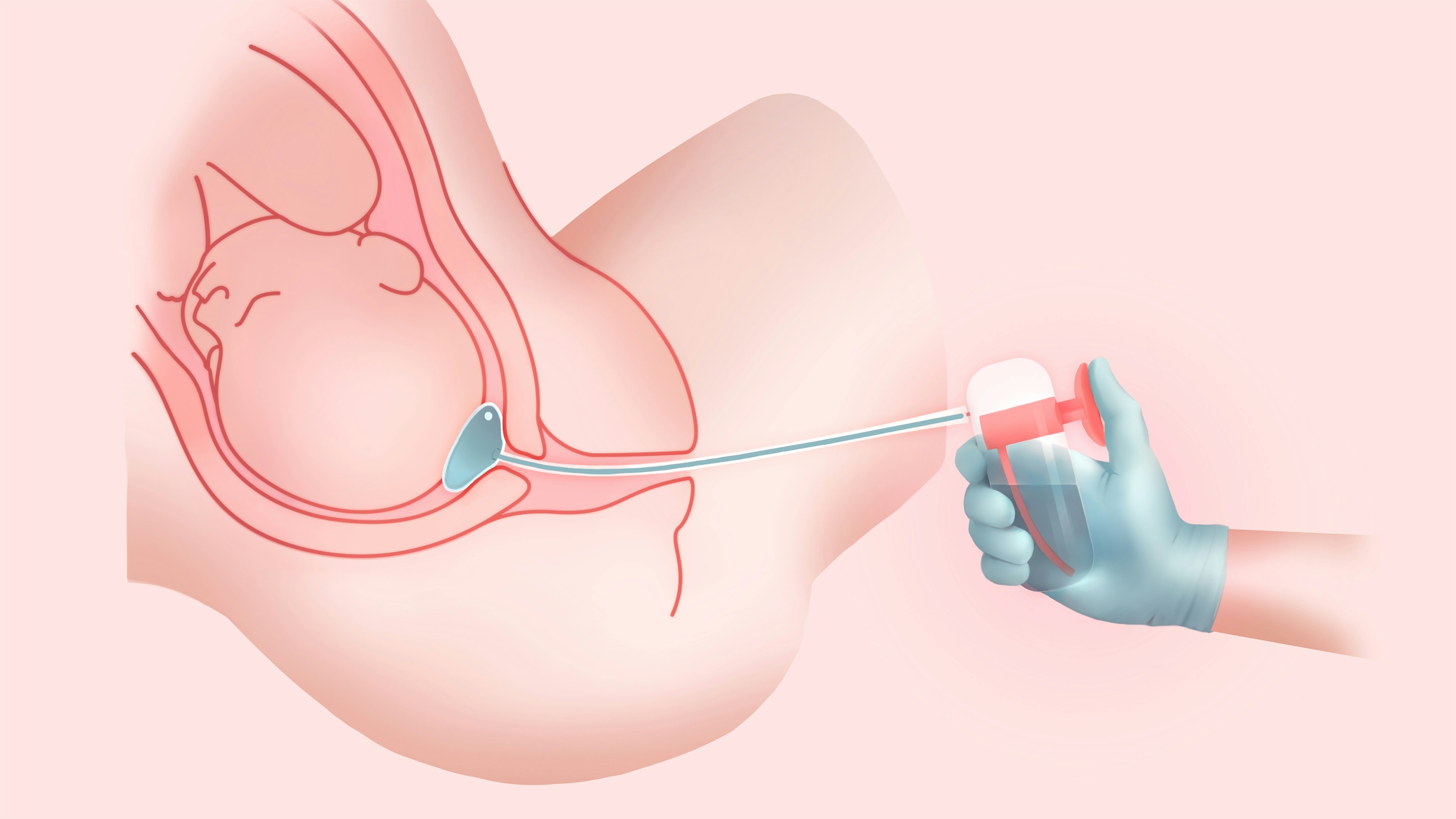Pregnant person and doctors hand displaying how the tool works. Illustration.